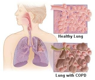 lung with copd